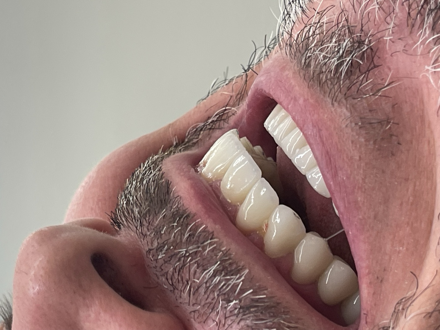Same patient's teeth after treatment at Domus Dent