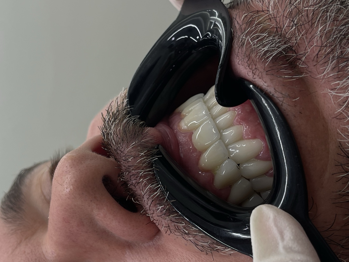 Same patient's teeth after treatment at Domus Dent
