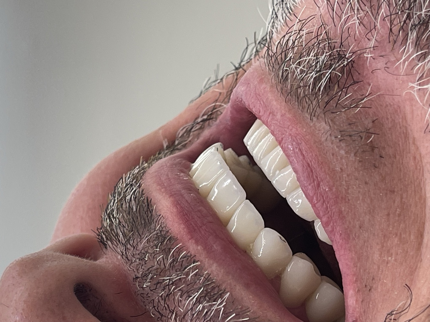Same patient's teeth after treatment at Domus Dent