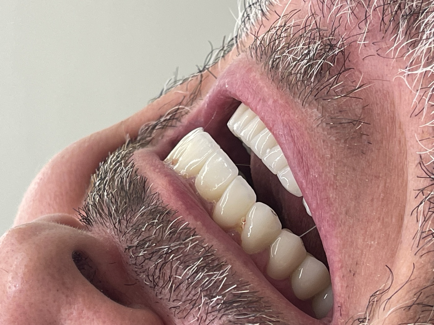 Same patient's teeth after treatment at Domus Dent