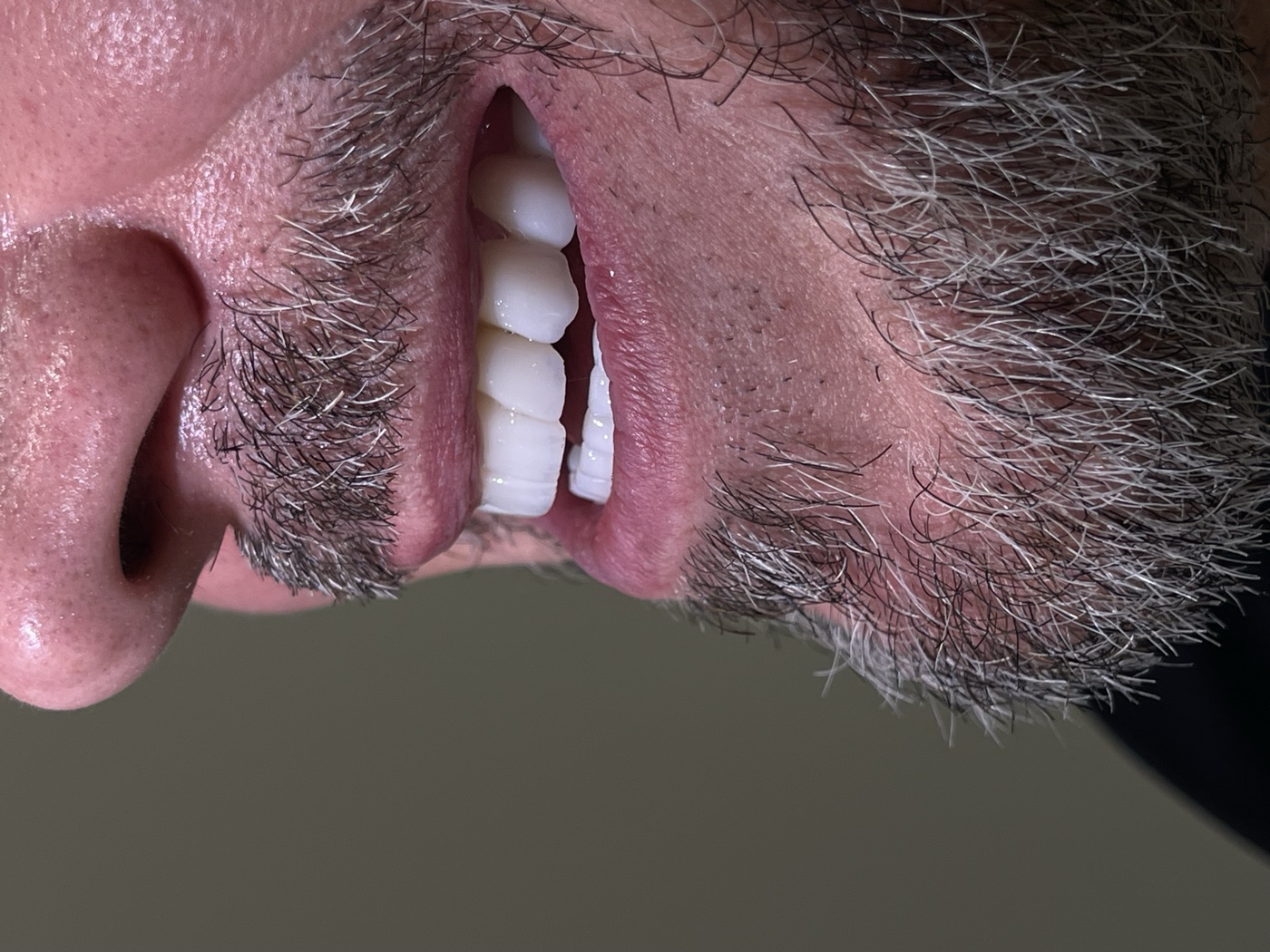 Same patient's teeth after treatment at Domus Dent