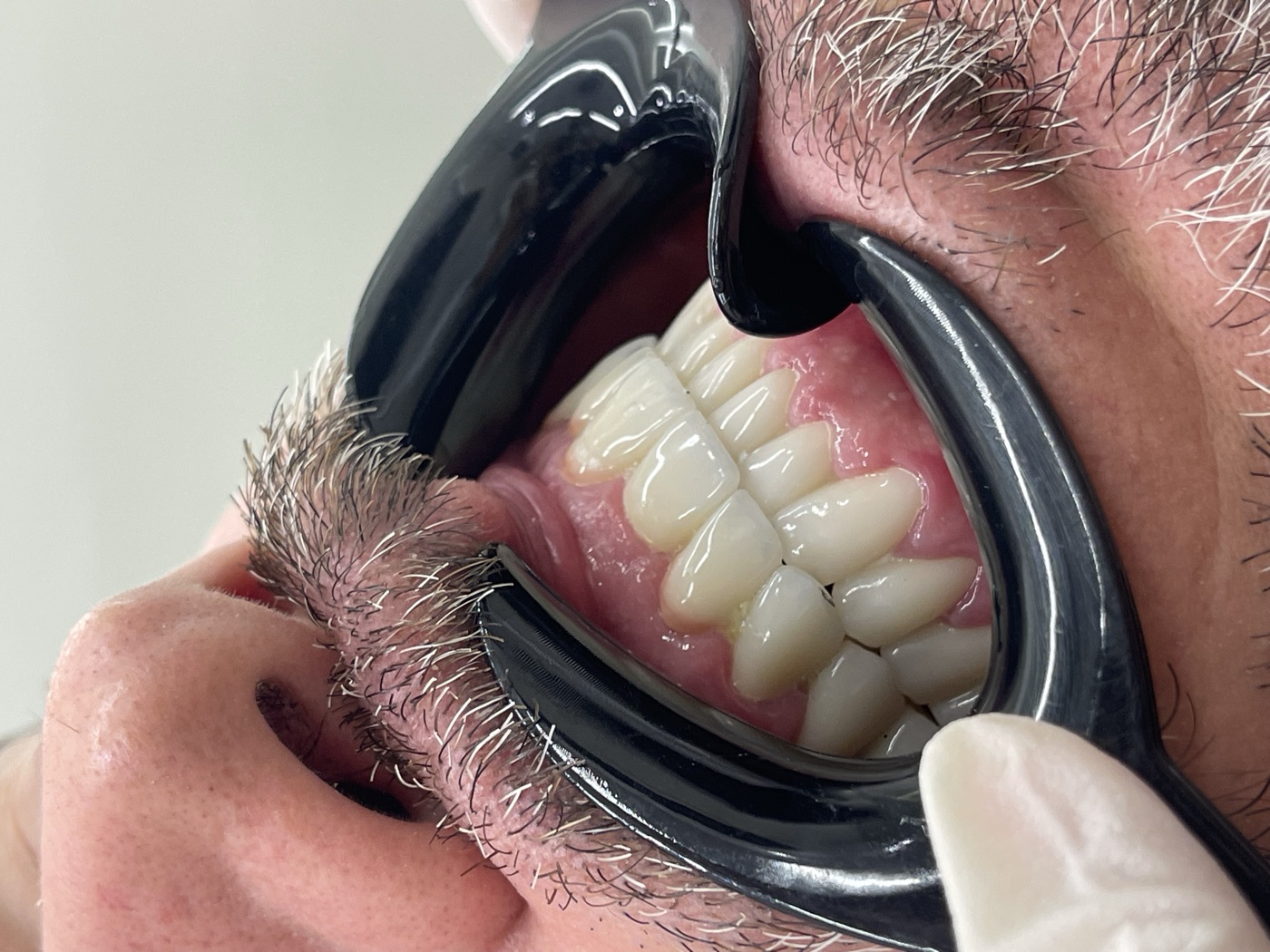 Same patient's teeth after treatment at Domus Dent